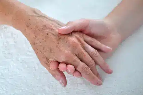 princiapais queixas de maos com manchas de sol