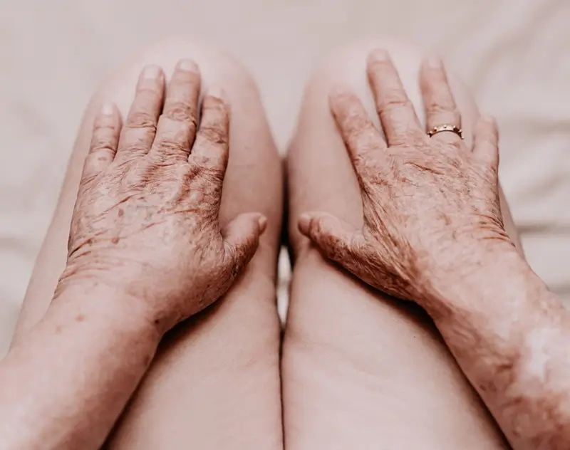 Veias aparentes e perda de volume nas mãos